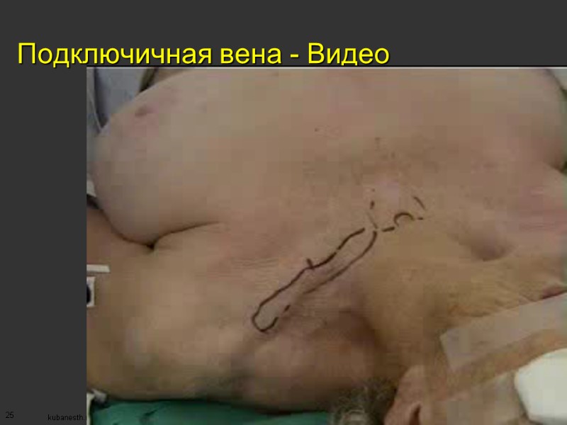 25 Подключичная вена - Видео